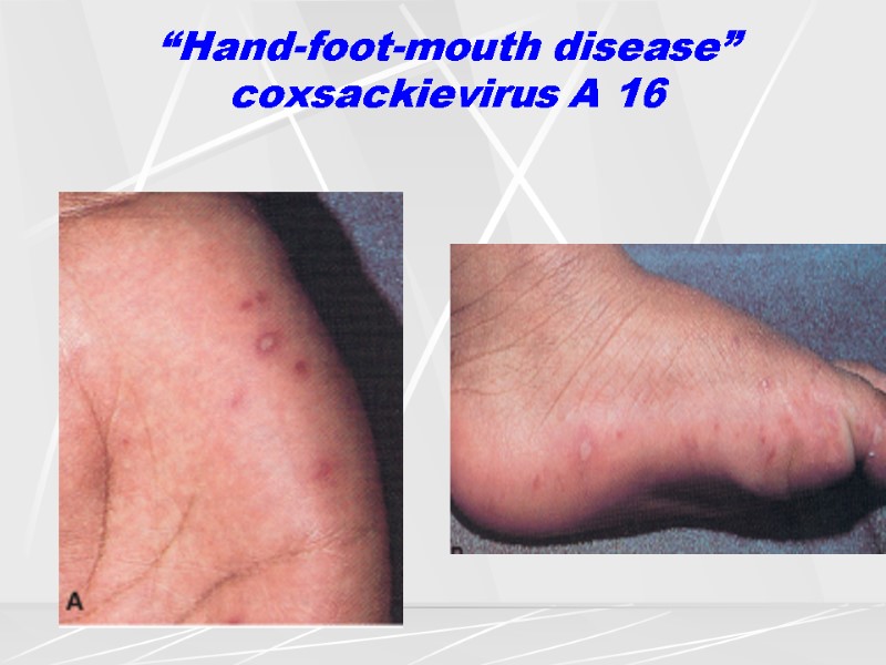 “Hand-foot-mouth disease”  coxsackievirus A 16